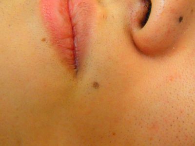 鼻下ひげ脱毛After