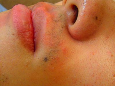 鼻下ひげ脱毛Before