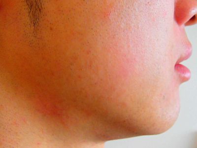 ほほひげ脱毛After