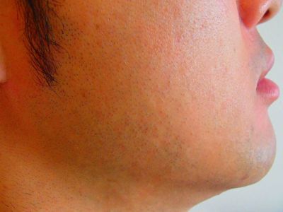 ほほひげ脱毛Before