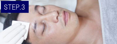 ほほヒゲ脱毛Step3