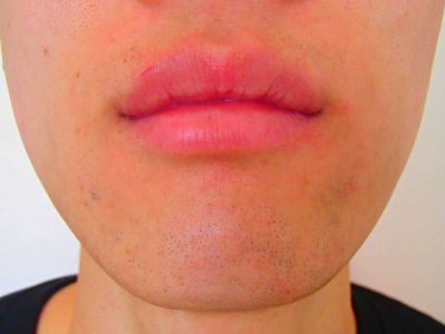 口下ひげ脱毛After