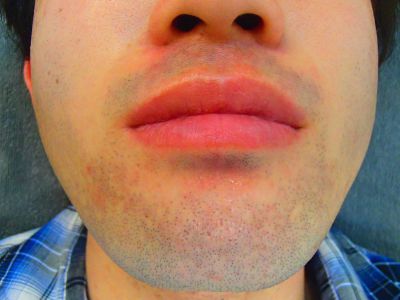 口下ひげ脱毛Before