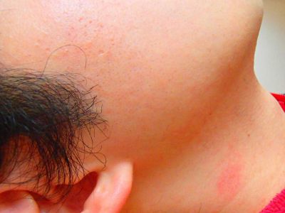 もみあげ脱毛After