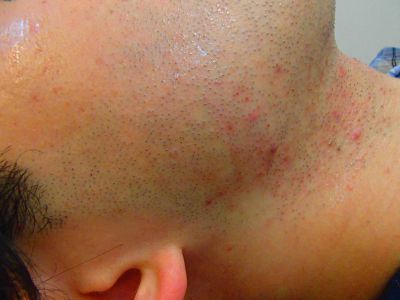 もみあげ脱毛Before