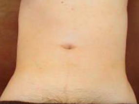 へそ周り脱毛After