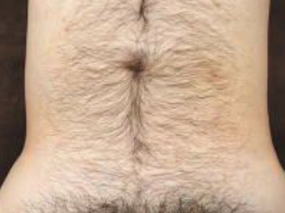 へそ周り脱毛Before