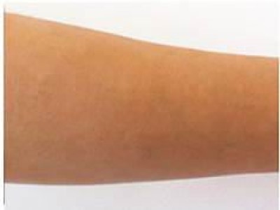 ひじ下脱毛After