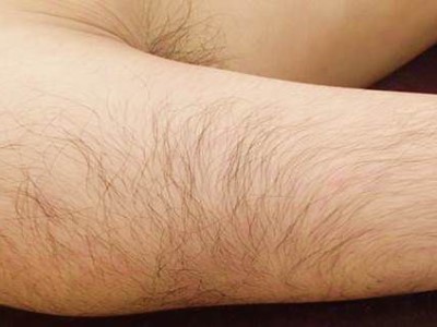 ひじ上脱毛Before
