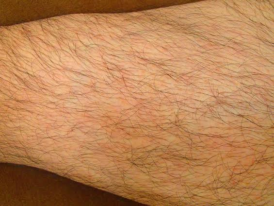 ひざ上脱毛Before