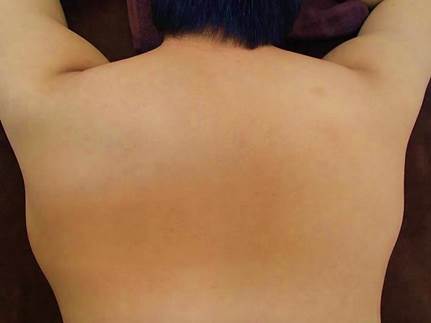 背中上脱毛After