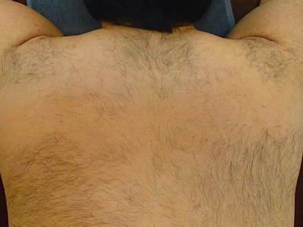 背中上脱毛Before